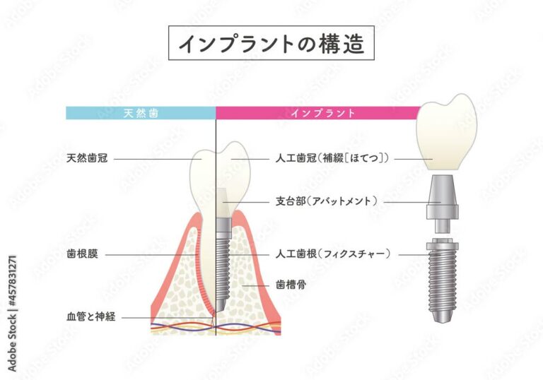 インプラントの構造