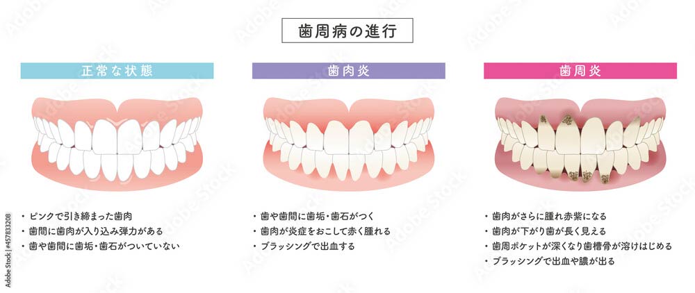 歯周病の進行